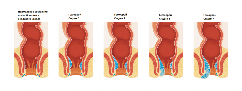 4-стадии-геморроя